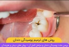 آشنایی با 8 علت پوسیدگی دندان و 4 روش درمان آن