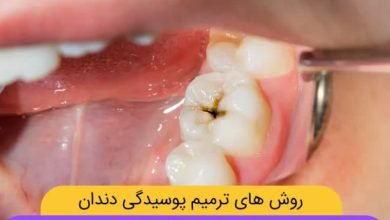 آشنایی با 8 علت پوسیدگی دندان و 4 روش درمان آن