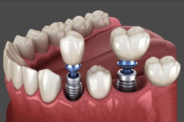 ایمپلنت دندان