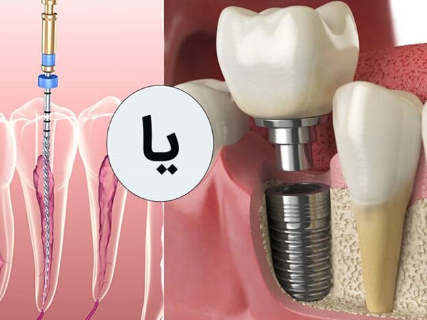 ایمپلنت دندان بهتر است یا عصب‌کشی دندان