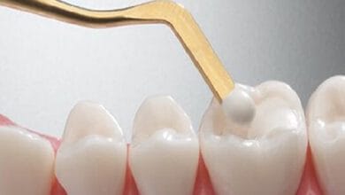 لمینت و کامپوزیت برای همه مناسب نیست