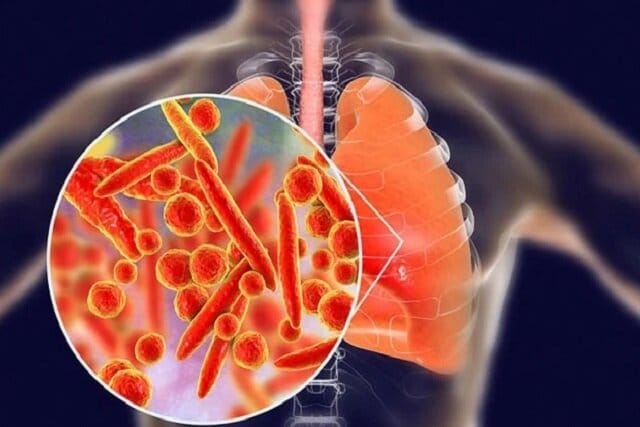 پنومونی؛ همچنان بزرگترین قاتل عفونی جهان
