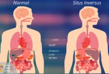 معکوس بودن اندام‌ها – ویروس کووید