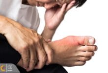 درمان فوری نقرس و خوراکی‌های مفید برای نقرس