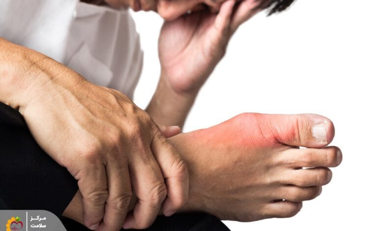 درمان فوری نقرس و خوراکیهای مفید برای نقرس