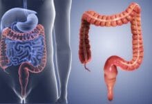 افزایش انسداد گوارشی ناشی از مصرف بی‌رویه «انار» و «خرمالو» در کودکان